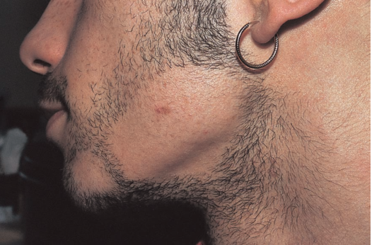 Alopecia areata