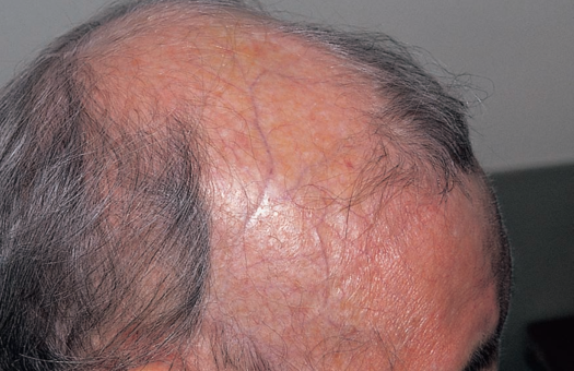 Alopecia secondary to radiation