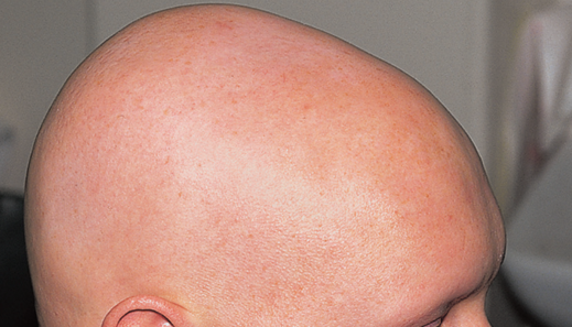 Alopecia universalis