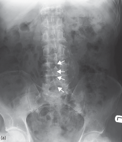 Calcified aortic aneurysm