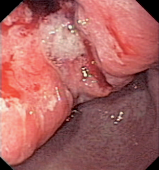 Cardiac carcinoma