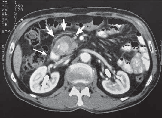 Hemosuccus pancreaticus