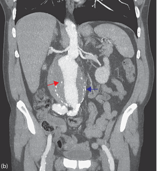 Infrarenal aortic aneurysm