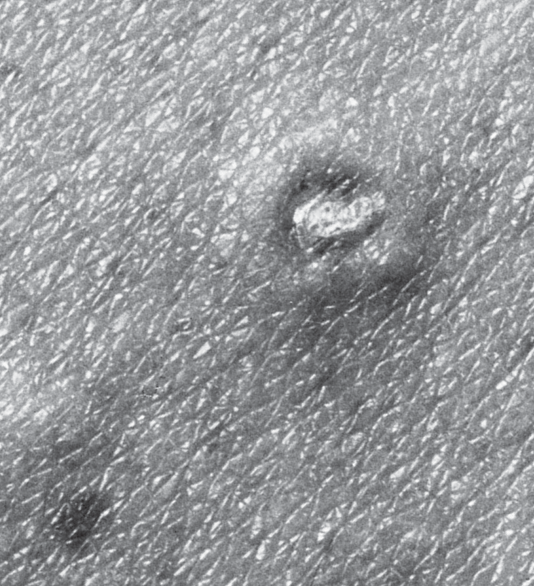 Köhlmeier−Degos syndrome