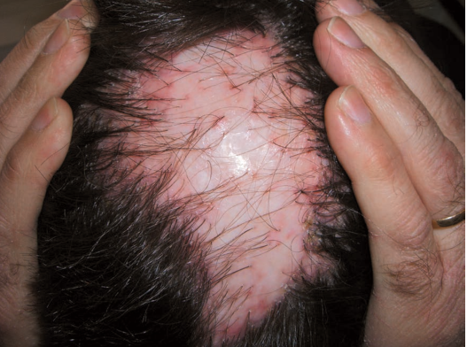 Lichen planus with scarring alopecia