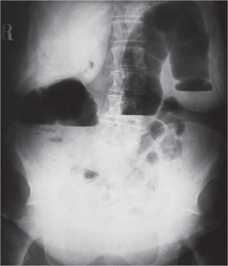 Mechanical ileus