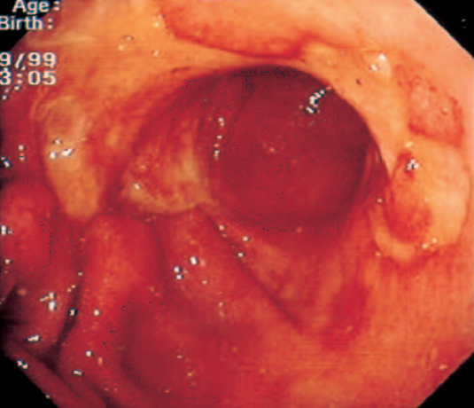 Melena and Non-Hodgkin lymphoma of the stomach