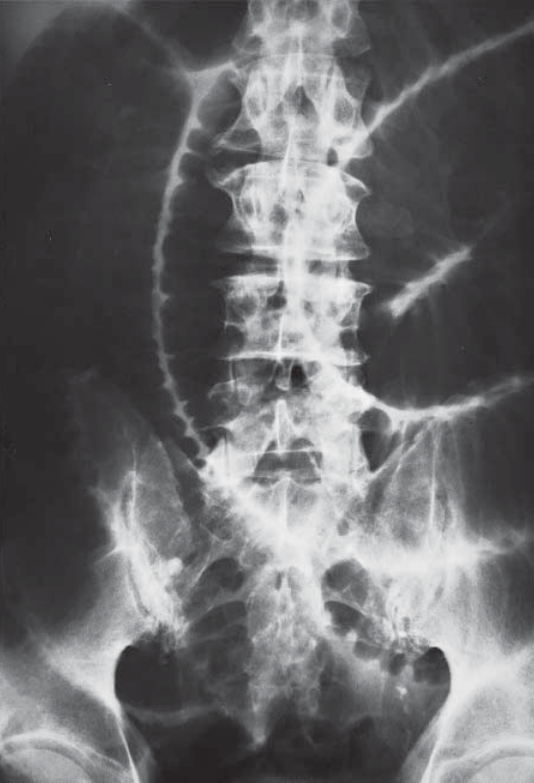 Paralytic Ileus