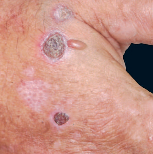 Porphyria cutanea tarda