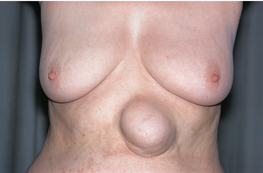 SWELLINGS IN THE ABDOMINAL WALL
