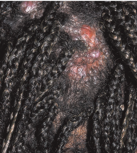 Traction alopecia